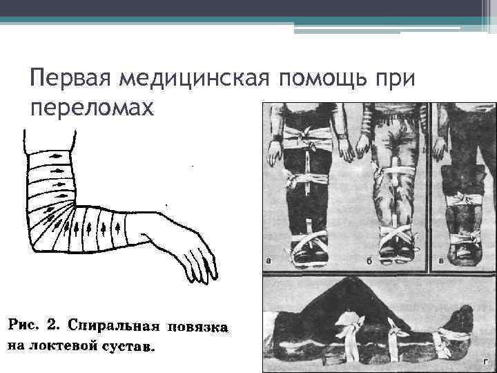 Первая медицинская помощь при переломах 