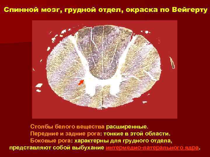 Спинной мозг, грудной отдел, окраска по Вейгерту Столбы белого вещества расширенные. Передние и задние