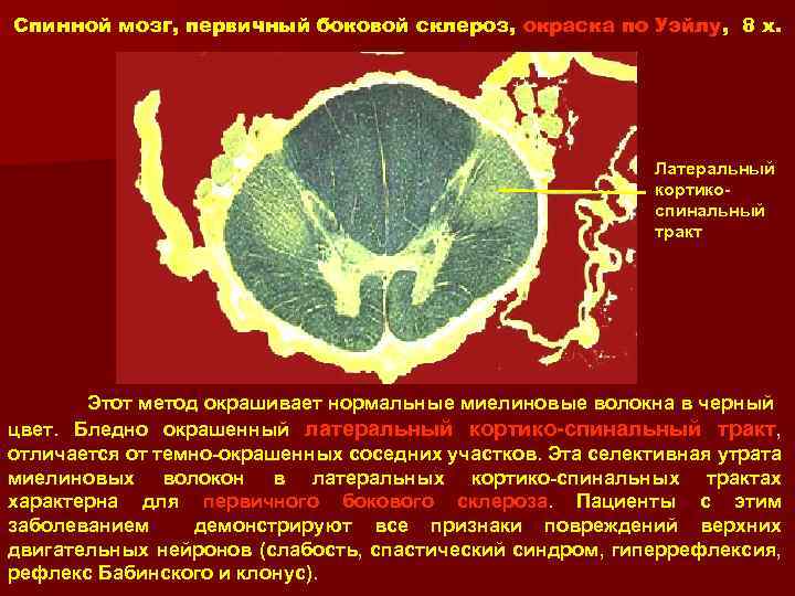 Спинной мозг, первичный боковой склероз, окраска по Уэйлу, 8 x. Латеральный кортикоспинальный тракт Этот