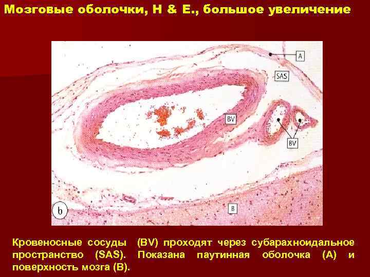 Мозговые оболочки, H & E. , большое увеличение Кровеносные сосуды пространство (SAS). поверхность мозга