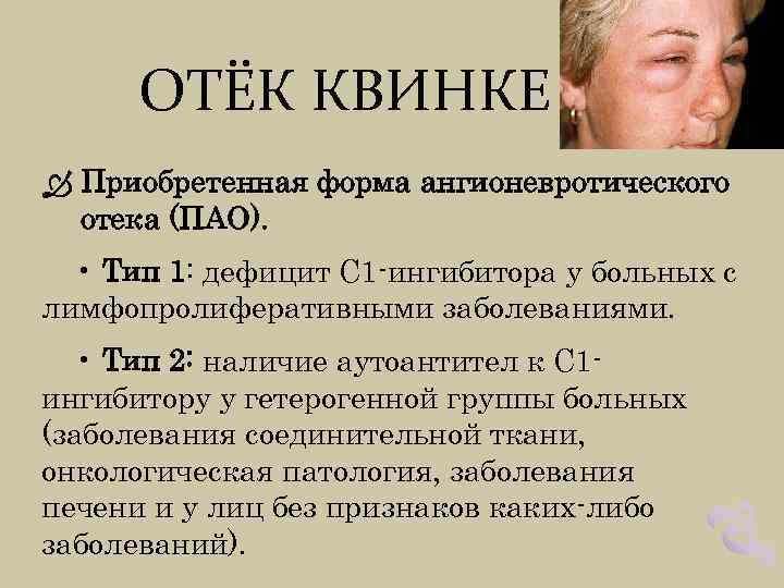 ОТЁК КВИНКЕ Приобретенная форма ангионевротического отека (ПАО). • Тип 1: дефицит С 1 -ингибитора