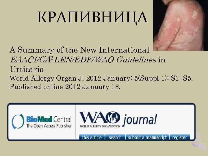 КРАПИВНИЦА A Summary of the New International EAACI/GA 2 LEN/EDF/WAO Guidelines in Urticaria World