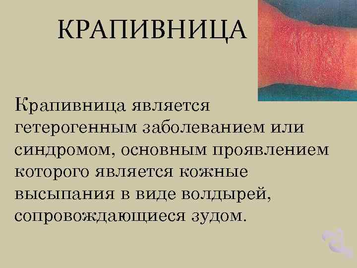 КРАПИВНИЦА Крапивница является гетерогенным заболеванием или синдромом, основным проявлением которого является кожные высыпания в