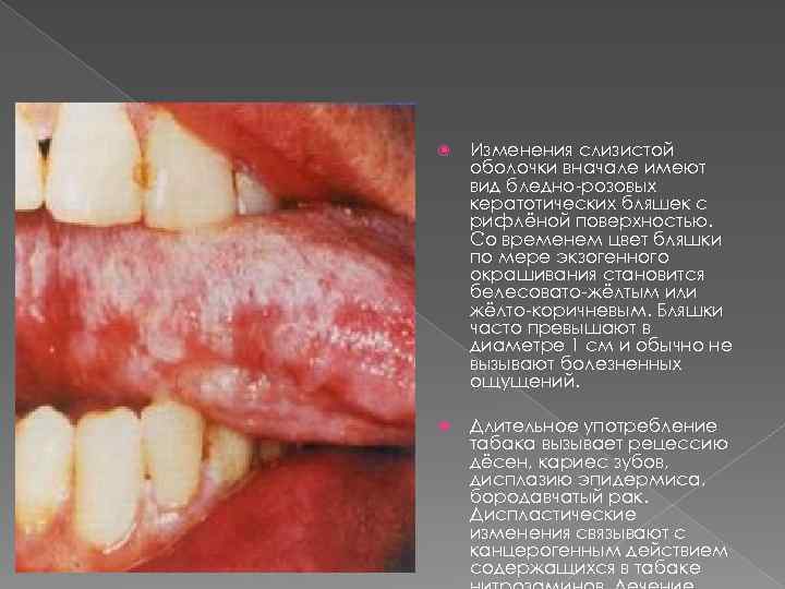 Изменения слизистой оболочки вначале имеют вид бледно-розовых кератотических бляшек с рифлёной поверхностью. Со