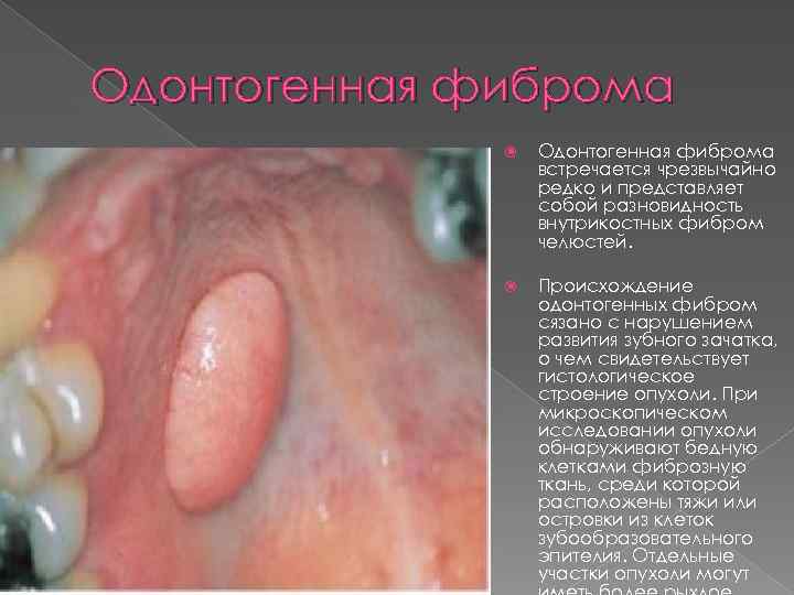 Одонтогенная фиброма встречается чрезвычайно редко и представляет собой разновидность внутрикостных фибром челюстей. Происхождение одонтогенных