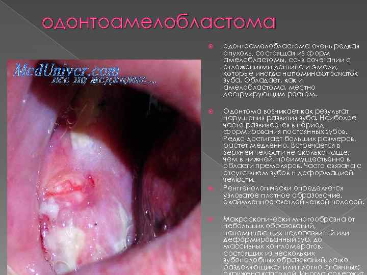 одонтоамелобластома очень редкая опухоль, состоящая из форм амелобластомы, сочв сочетании с отложениями дентина и
