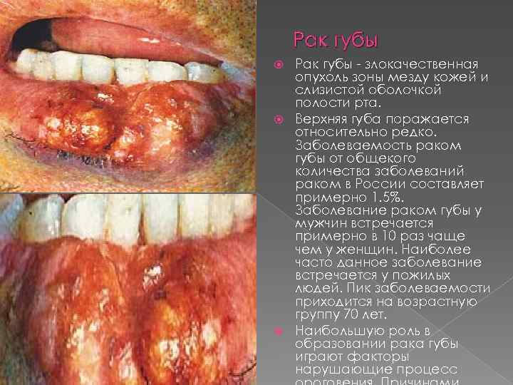 Рак губы - злокачественная опухоль зоны мезду кожей и слизистой оболочкой полости рта. Верхняя