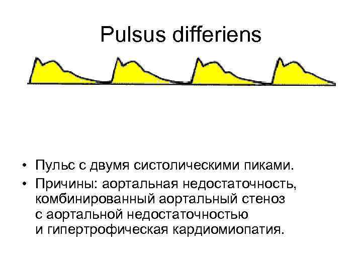 Pulsus differiens • Пульс с двумя систолическими пиками. • Причины: аортальная недостаточность, комбинированный аортальный