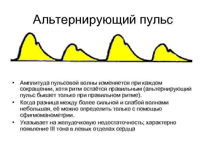 Альтернирующий пульс • Амплитуда пульсовой волны изменяется при каждом сокращении, хотя ритм остаётся правильным
