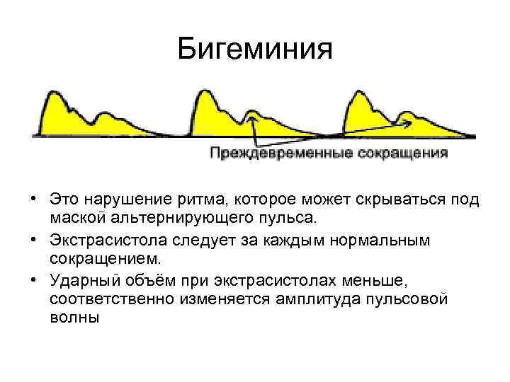Бигеминия • Это нарушение ритма, которое может скрываться под маской альтернирующего пульса. • Экстрасистола