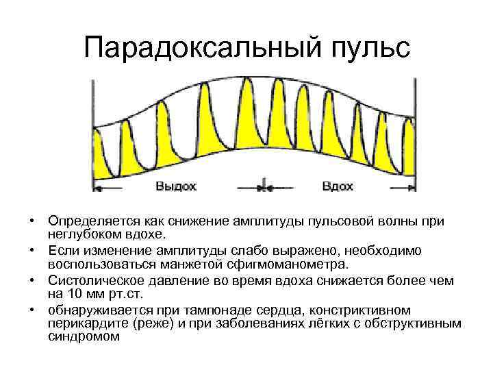 Парадоксальный пульс • Определяется как снижение амплитуды пульсовой волны при неглубоком вдохе. • Если