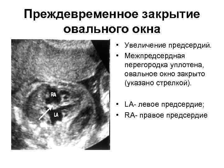 Преждевременное закрытие овального окна • Увеличение предсердий. • Межпредсердная перегородка уплотена, овальное окно закрыто
