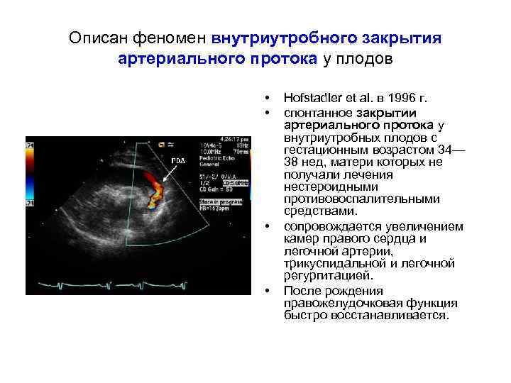 Описан феномен внутриутробного закрытия артериального протока у плодов • • Hofstadler et al. в
