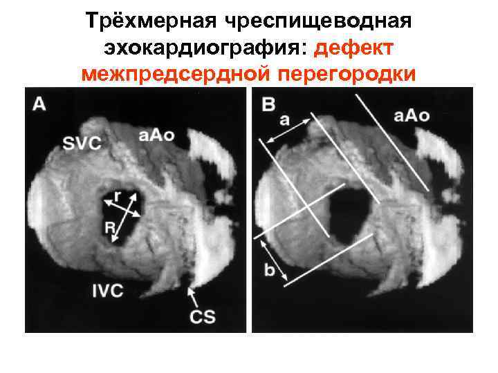 Трёхмерная чреспищеводная эхокардиография: дефект межпредсердной перегородки 