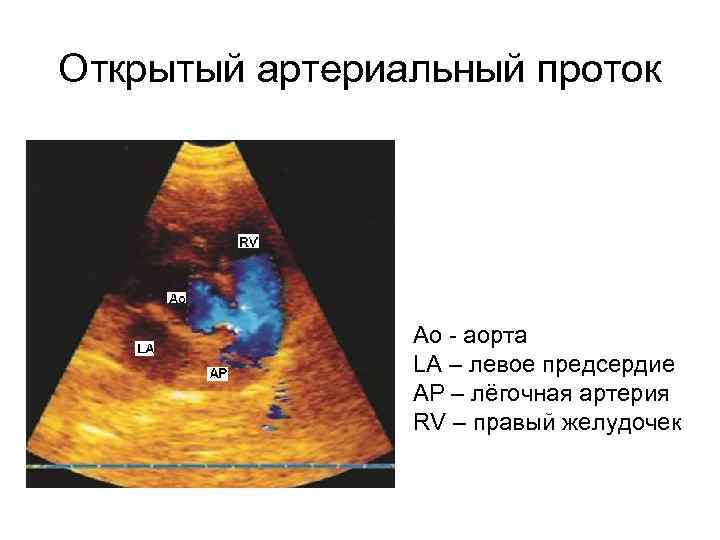 Открытый артериальный проток Ao аорта LA – левое предсердие AP – лёгочная артерия RV