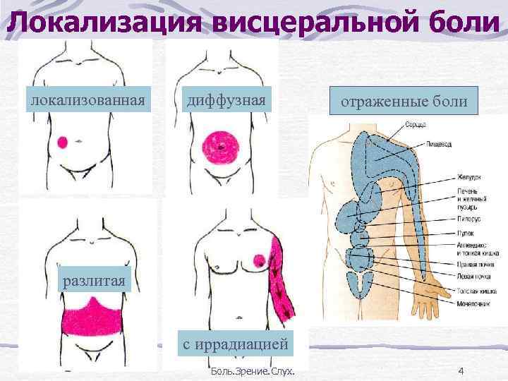 Локализация боли в животе. Локализация висцеральной боли. Локализация болей схема. Локализация и иррадиация боли.