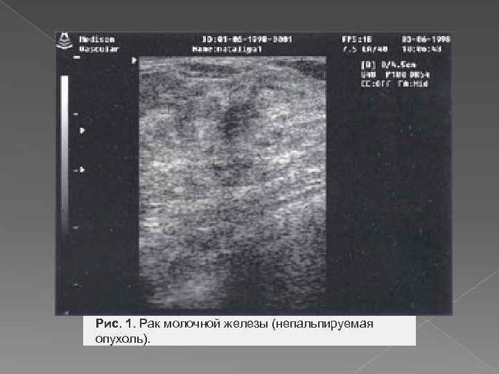  Рис. 1. Рак молочной железы (непальпируемая опухоль). 