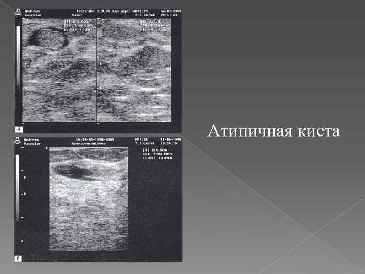 Атипичная киста 