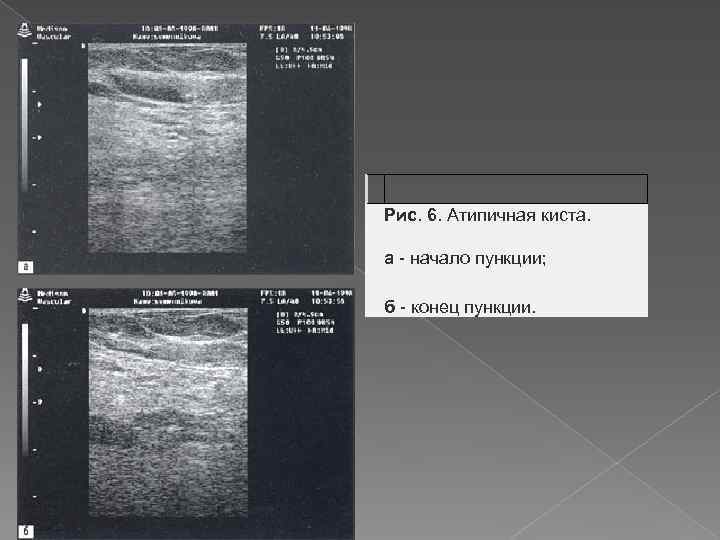  Рис. 6. Атипичная киста. а - начало пункции; б - конец пункции. 