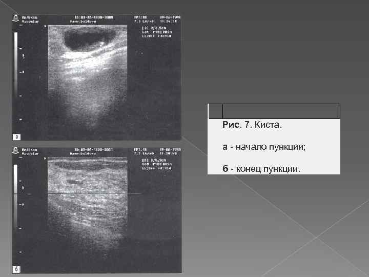  Рис. 7. Киста. а - начало пункции; б - конец пункции. 