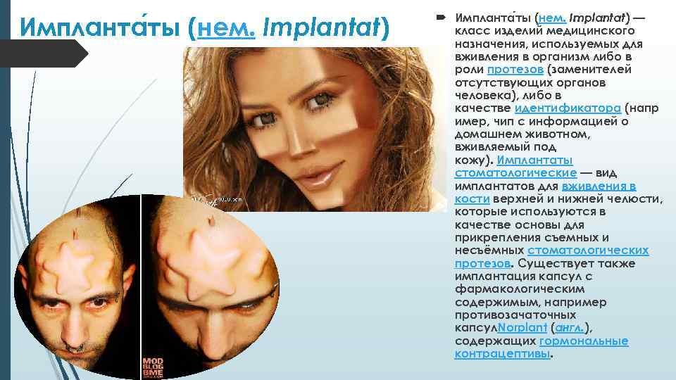 Импланта ты (нем. Implantat) — класс изделий медицинского назначения, используемых для вживления в организм