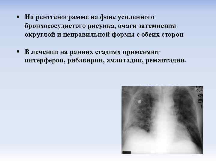 Усилен сосудистый компонент легочного рисунка