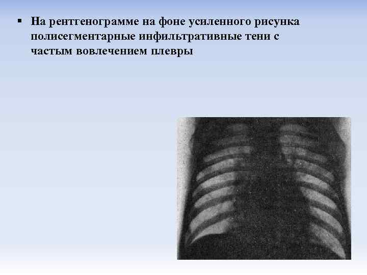 § На рентгенограмме на фоне усиленного рисунка полисегментарные инфильтративные тени с частым вовлечением плевры