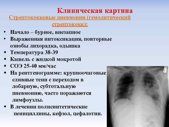 Хламидийная пневмония рентгенологическая картина - 85 фото