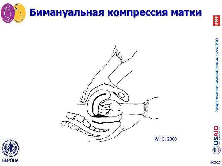 Эффективная перинатальная помощь и уход (ЭПУ) Бимануальная компрессия матки WHO, 2000 4 MO-25 