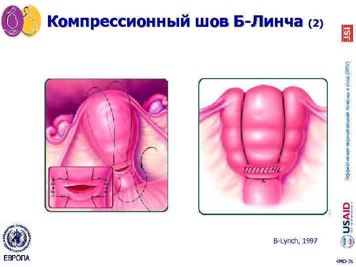 Эффективная перинатальная помощь и уход (ЭПУ) Компрессионный шов Б-Линча (2) B-Lynch, 1997 4 MO-31
