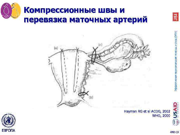 Эффективная перинатальная помощь и уход (ЭПУ) Компрессионные швы и перевязка маточных артерий Hayman RG