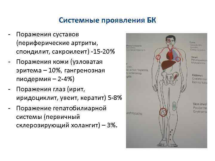 Стул при болезни крона