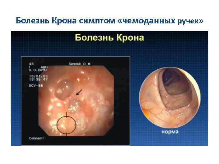 Болезнь Крона симптом «чемоданных ручек» 