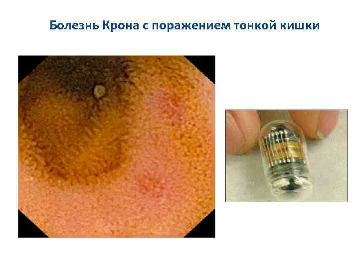 Болезнь Крона с поражением тонкой кишки 