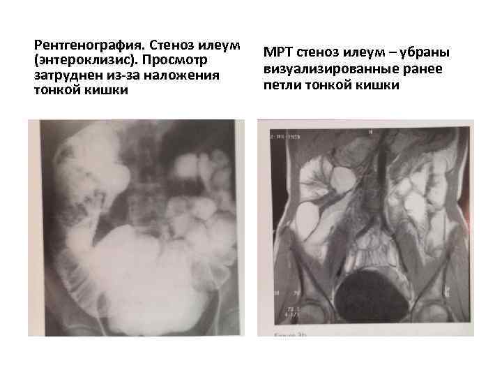 Стул при болезни крона