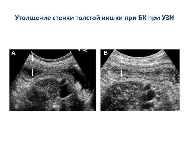 Утолщение стенок. Утолщение стенки кишки на УЗИ. Утолщение стенок желудка на УЗИ. Утолщение стенки Толстого кишечника по УЗИ.