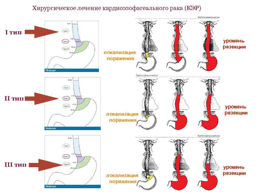 Хирургическое лечение кардиоэзофагеального рака (КЭР) I тип локализация поражения уровень резекции II тип локализация