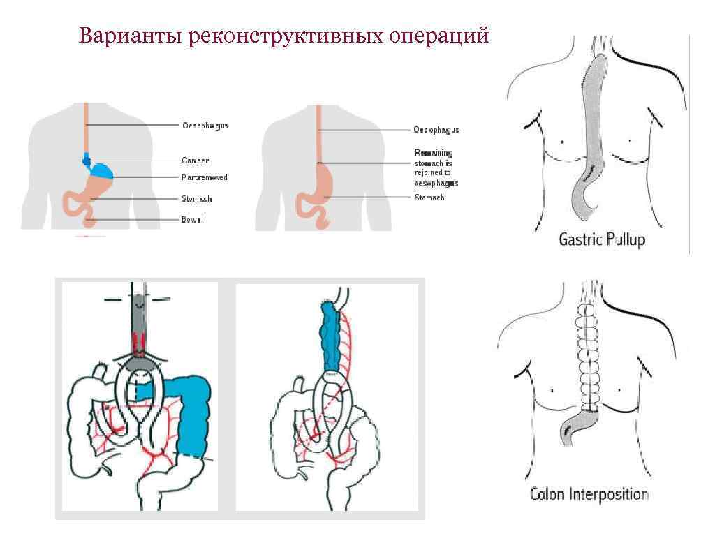 Варианты реконструктивных операций 