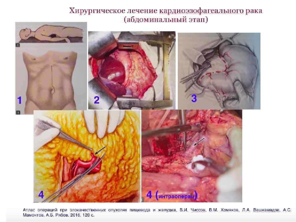 Кардиоэзофагеальный переход с хроническим воспалением