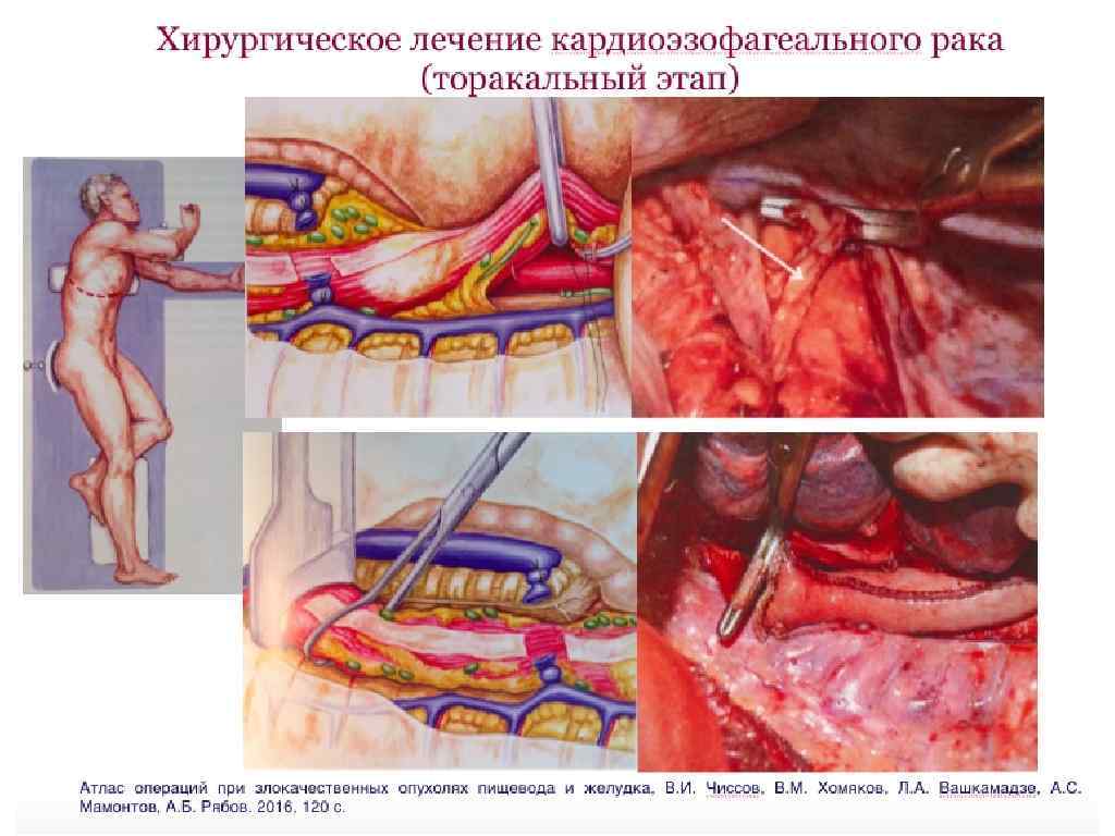 Кардиоэзофагеальный переход с хроническим воспалением