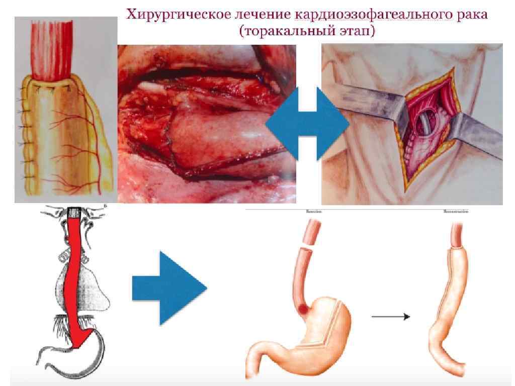 Кардиоэзофагеальный переход с хроническим воспалением