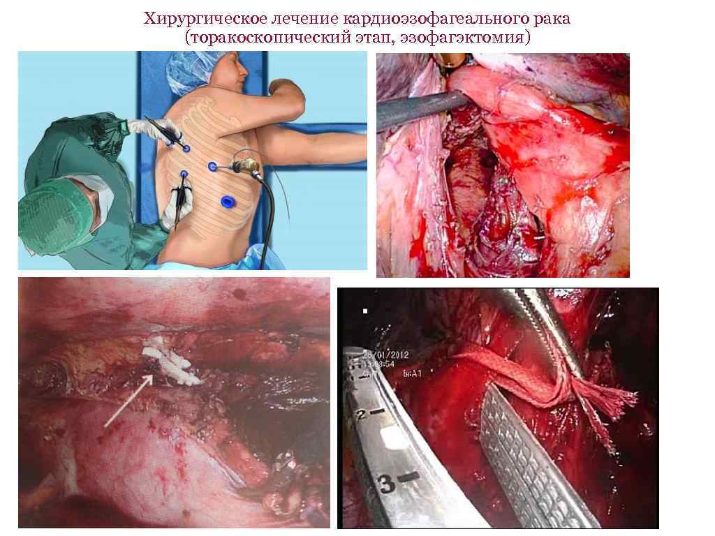 Хирургическое лечение кардиоэзофагеального рака (торакоскопический этап, эзофагэктомия) 