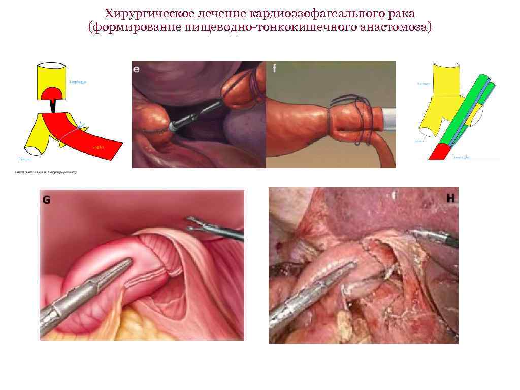 Хирургическое лечение кардиоэзофагеального рака (формирование пищеводно-тонкокишечного анастомоза) 