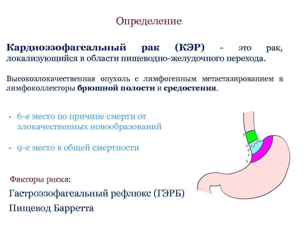 Определение Кардиоэзофагеальный рак (КЭР) - это рак, локализующийся в области пищеводно-желудочного перехода. Высокозлокачественная опухоль