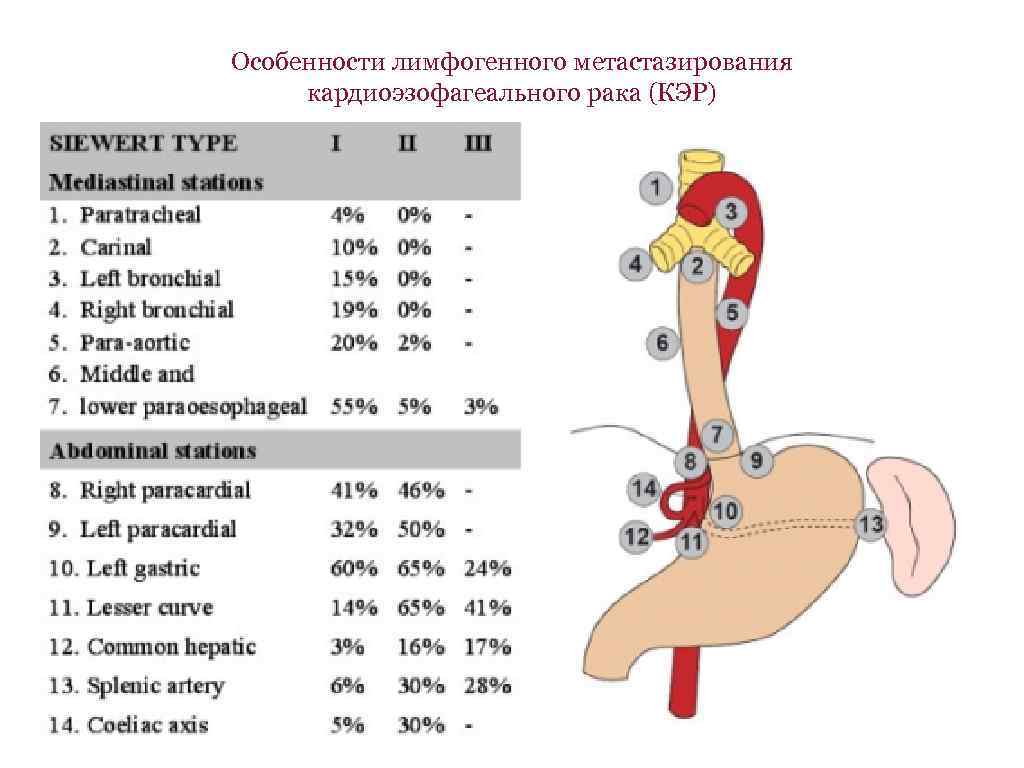 Особенности лимфогенного метастазирования кардиоэзофагеального рака (КЭР) 
