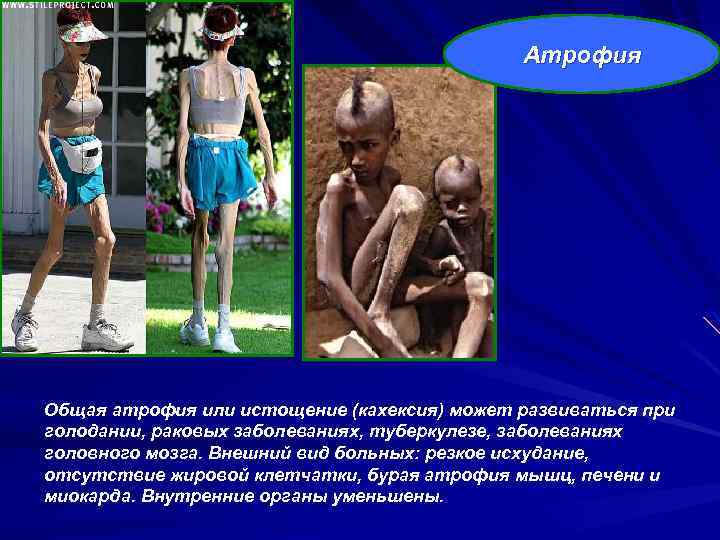 Атрофия Общая атрофия или истощение (кахексия) может развиваться при голодании, раковых заболеваниях, туберкулезе, заболеваниях