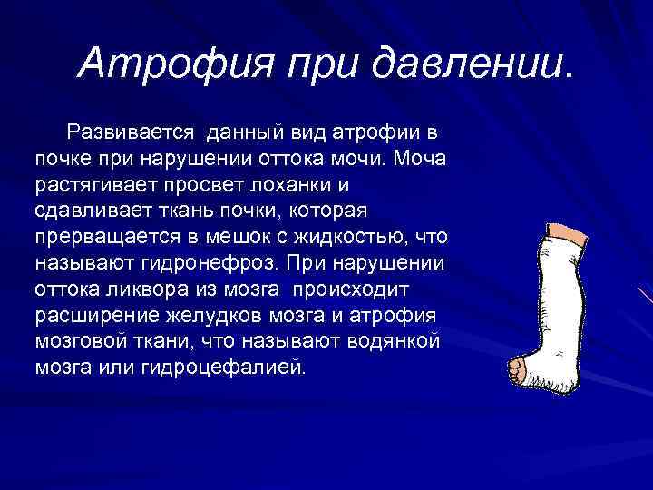 Атрофия при давлении. Развивается данный вид атрофии в почке при нарушении оттока мочи. Моча