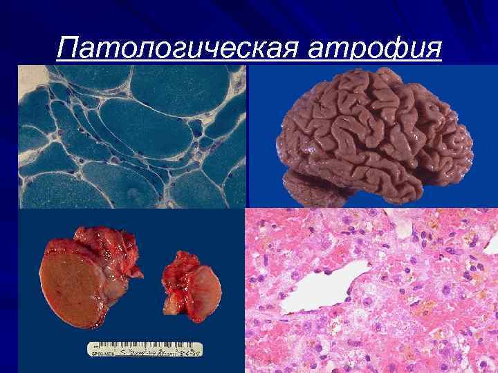 Патологическая атрофия 