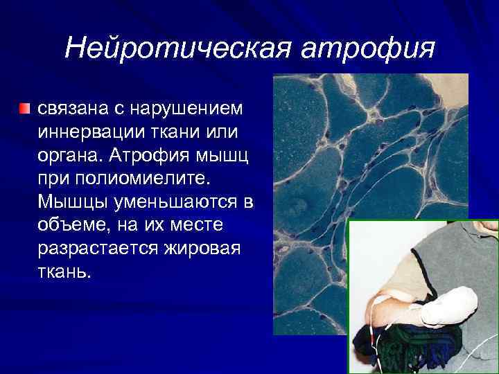 Мышечная атрофия. Нейротическая атрофия. Нейротическая атрофия скелетной мышцы. Нейротическая атрофия скелетной мышцы причины. Нейротическая атрофия заболевания.