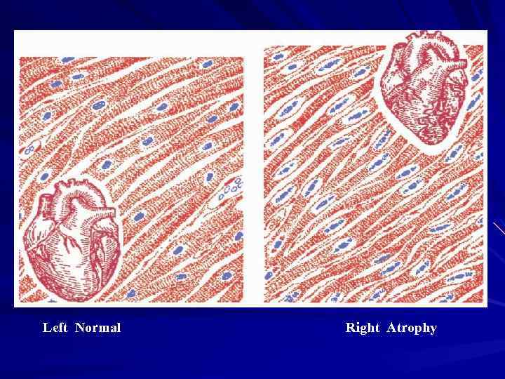 Left Normal Right Atrophy 